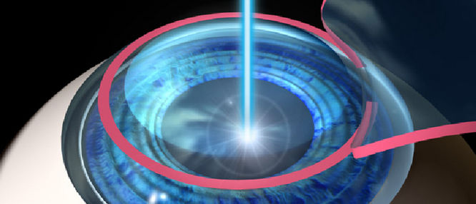 Τέλος στους φακούς επαφής βάζει επέμβαση laser 8ης γενιάς